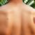 Przebarwienia na plecach: przyczyny, profilaktyka i skuteczne metody redukcji zmian pigmentacyjnych