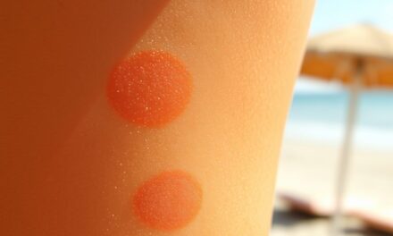 Przebarwienia posłoneczne: przyczyny, profilaktyka i bezpieczne metody redukcji zmian pigmentacyjnych